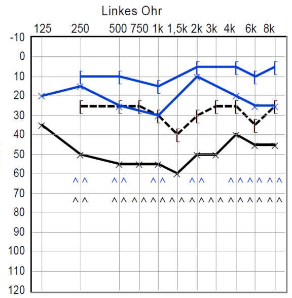 otosklerose_hoerverbesserung_nach_op.png 