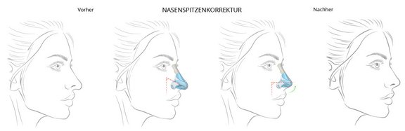 Nasenspitzenkorrektur