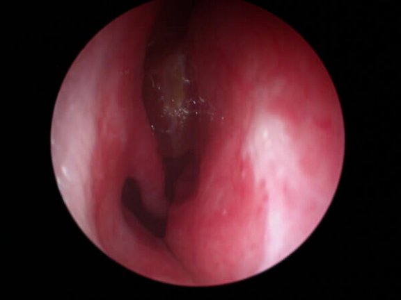 Untere Nasenmuschel und Polyp von Weitem