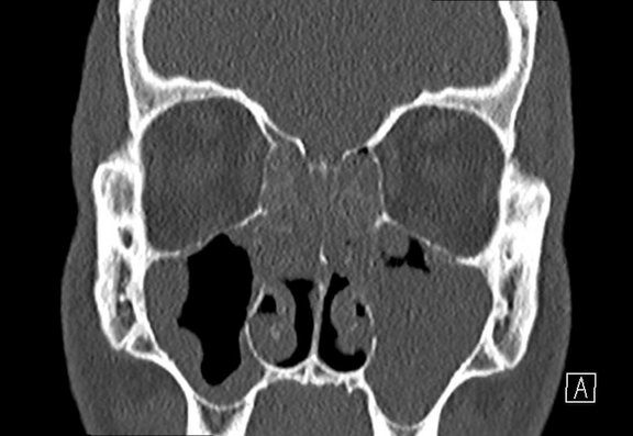 Ausgeprägte chronische Sinusitis CT