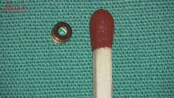 Darstellung des Größenverhältnisses einer Paukendrainage zu einem Streichholzkopf.