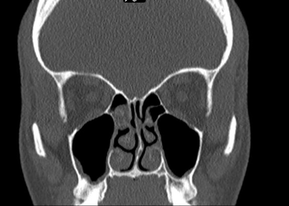 Gering ausgeprägte chronische Sinusitis