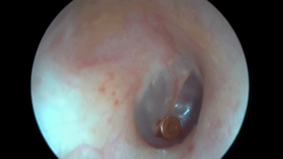 Paukendrainage im Trommelfell eingelegt. Die Belüftung erfolgt nunmehr nicht mehr über den natürlichen Weg durch die Ohrtrompete, sondern das Mittelohr wird durch die Paukendrainage belüftet. 