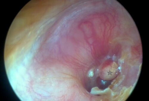 Hier liegt ein so genannter Signalpolyp (Sternchen )vor. Der Polyp entsteht durch die chronische Entzündung. Hier muss nicht unbedingt ein Cholesteatom vorliegen, da ein solcher Polyp auch durch eine länger andauernde Gehörgangsentzündung auftreten kann, aber der Polyp ist hochverdächtig auf das Vorliegen eines Cholesteatoms. Weitere Schritte sind notwendig.