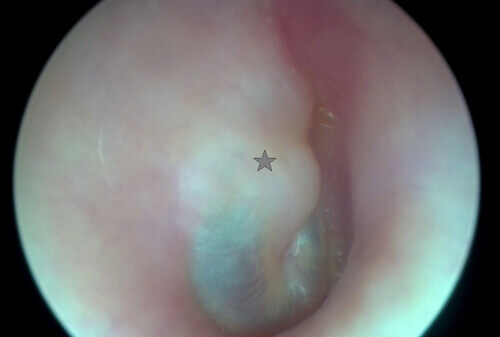 Das Sternchen zeigt hier einen Bereich, bei dem es so wirkt, als wenn Etwas hinter dem Trommelfell wachsen würde. Ein solcher Befund ist verdächtig auf ein Cholesteatom. Hier konnte aber mittels Computertomografie und Magnetresonanztomographie ein Cholesteatom ausgeschlossen werden.