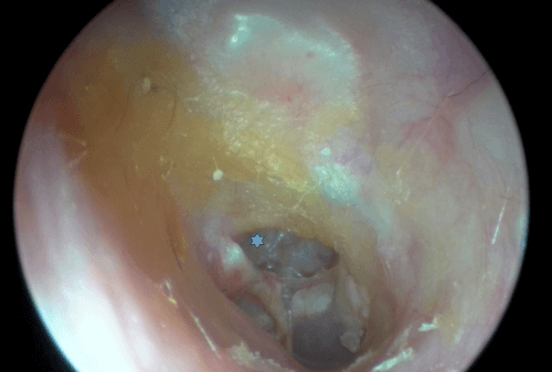 Hier erkennt man das Cholesteatom im hinteren oberen Quadranten. Das Sternchen markiert die tiefere Retraktion, die durch die Zerstörung des Gehörgangs in diesem Bereich entstanden ist.