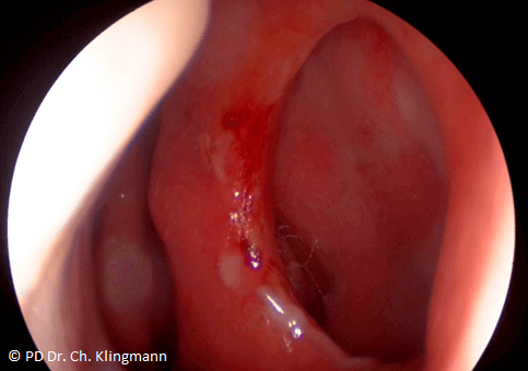 Endoskopischer Blick durch das rechte Nasenloch: kreisrunde Septumperforation, die den Blick in die linke Nasenhaupthöhle ermöglicht.