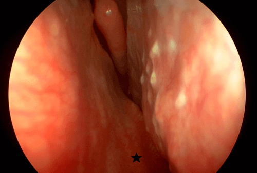 Blick in das linke Nasenloch: Hier blockiert die verkrümmte Nasenscheidewand (*) den gesamten unteren Nasengang. Die Atmung ist hierdurch sehr deutlich eingeschränkt.