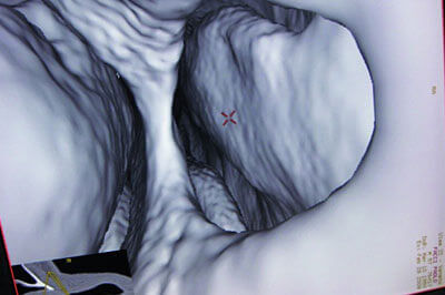 große Septumperforation - virtuelle 3D-Endoskopie