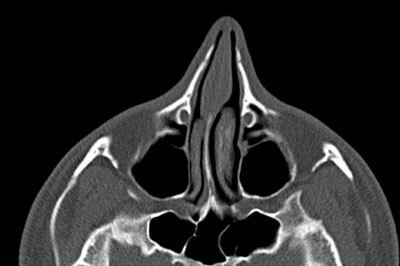 CT verkrümmte Nasenscheidewand