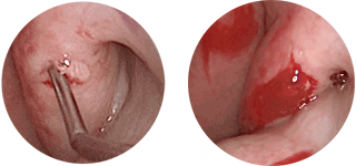 Klaffende Tube und Beginn Einspritzung Hyaloronsäure (links) Post OP - Tube mit Füllmaterial verengt (rechts)