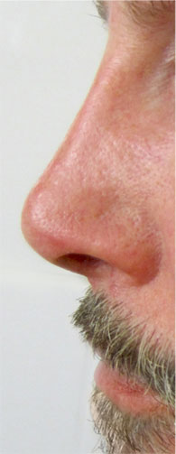 septorhinoplastik.jpg 